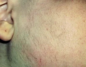After Laser Hair Removal Treatment