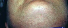 After Laser Hair Removal Treatment