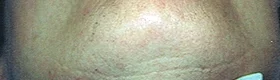 After Laser Hair Removal Treatment