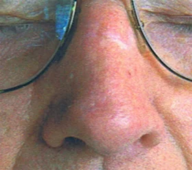After Laser Skin Rejuvenation