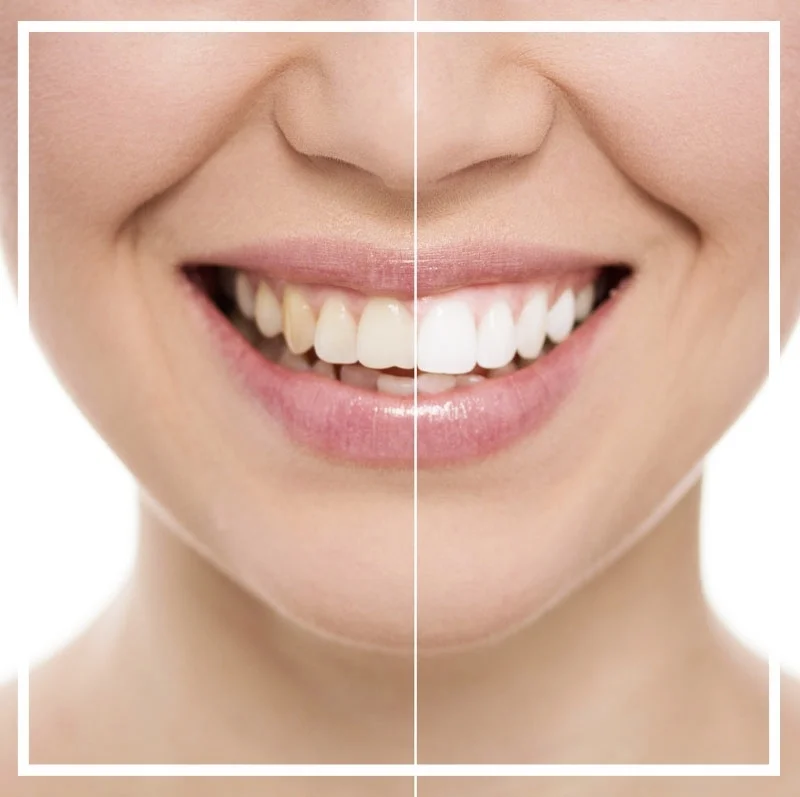 teeth-whitening.jpg