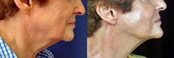 mini-facelift-retief-skin-center-1.jpg