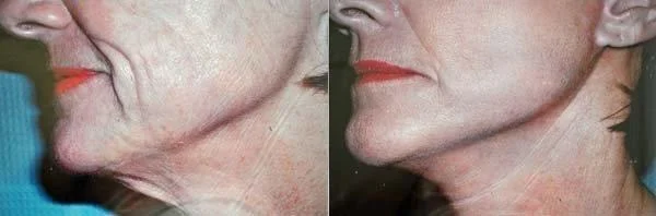 mini-facelift-retief-skin-center-2.jpg