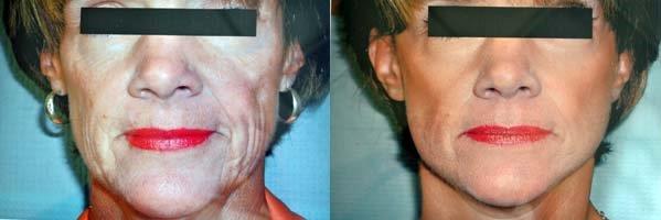 mini-facelift-retief-skin-center-3.jpg