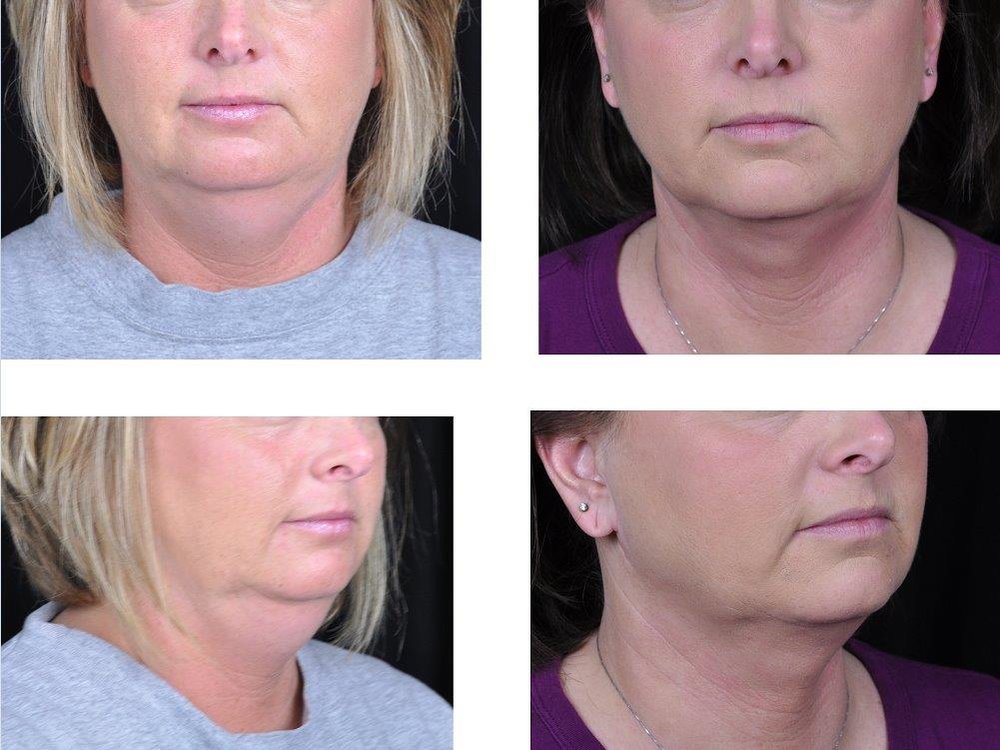 neck-face-liposuction-retief-skin-center-1.jpg