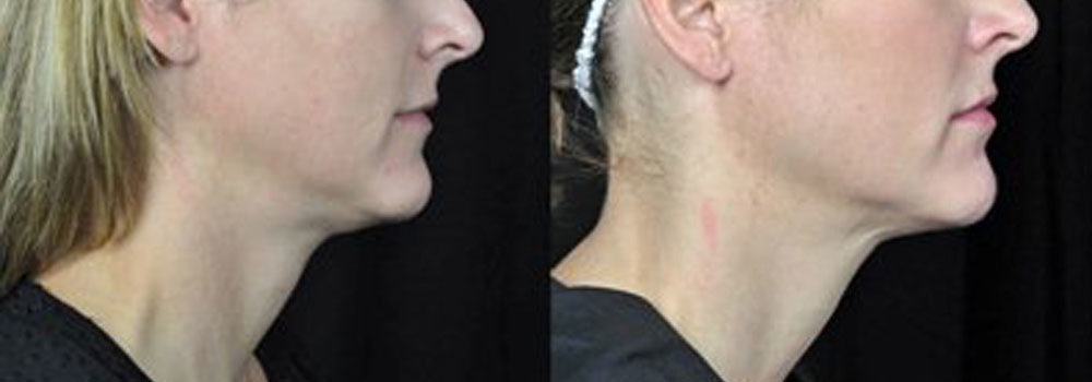neck-face-liposuction-retief-skin-center-3.jpg