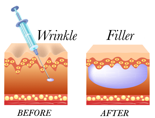 dermal-fillers-illustration.png