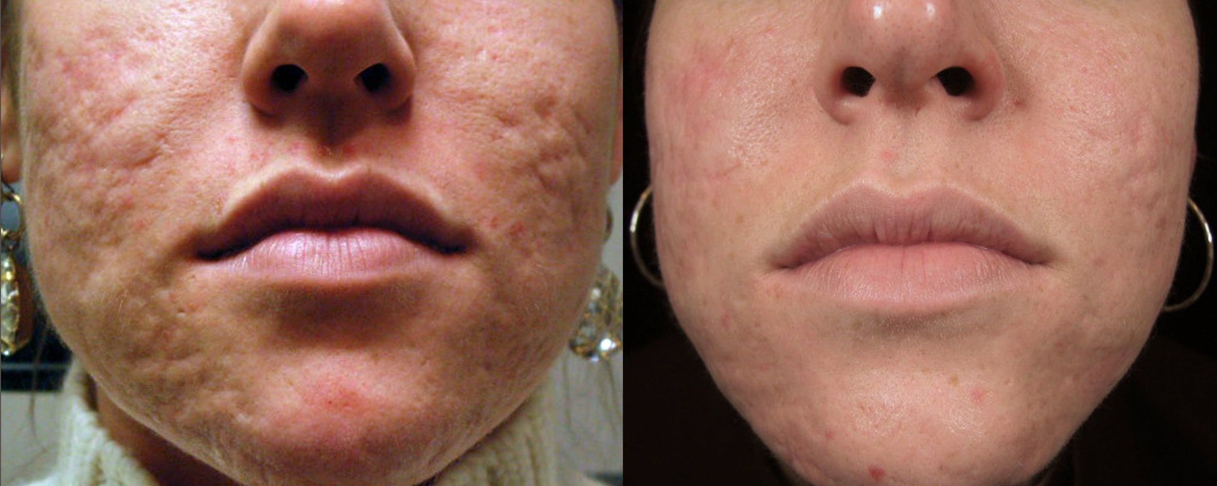 laser per cicatrici da acne