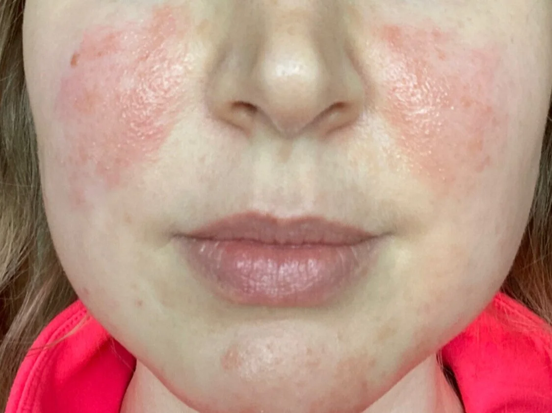 rosacea acne reddit