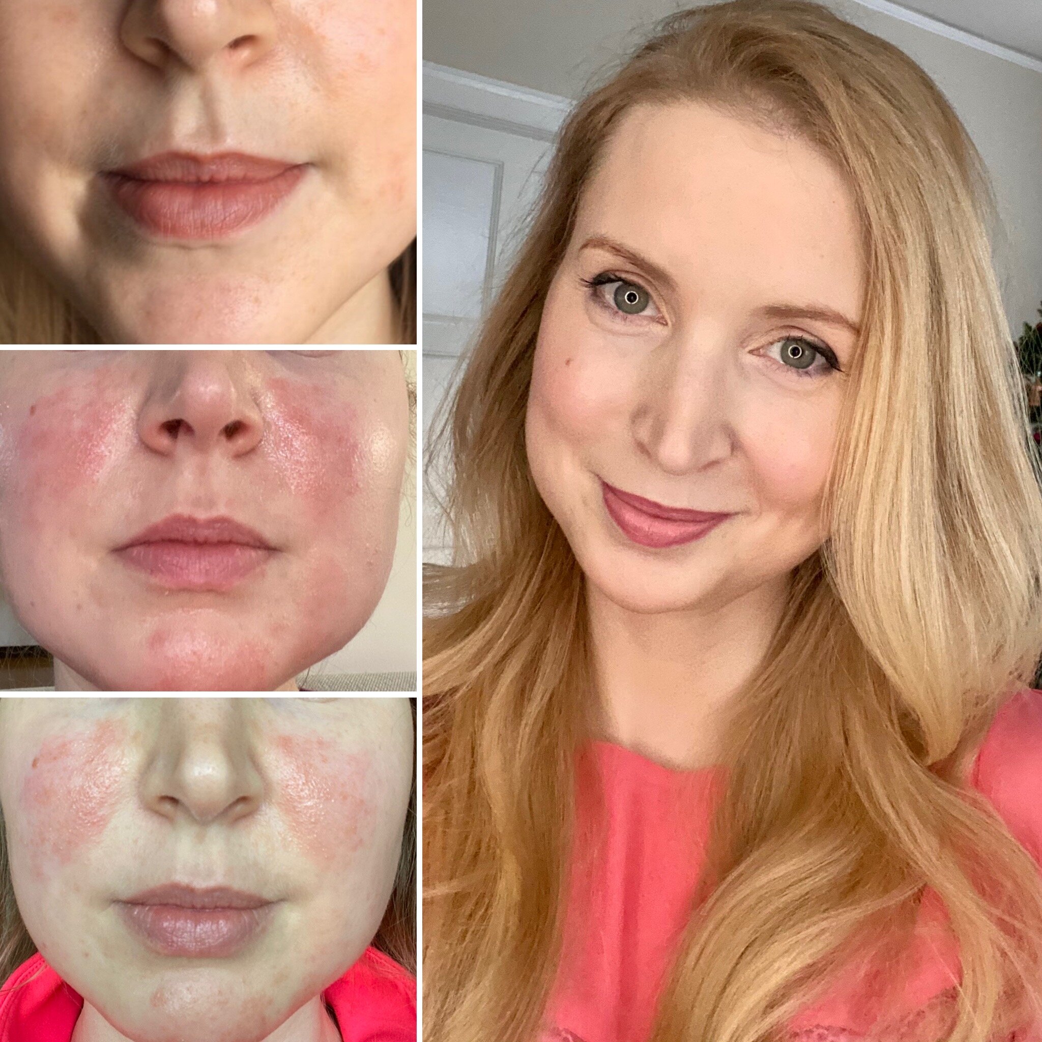 healthHackers - Perioral dermatitis journey: the wonder drink, comeback, the staph infection and the clear up