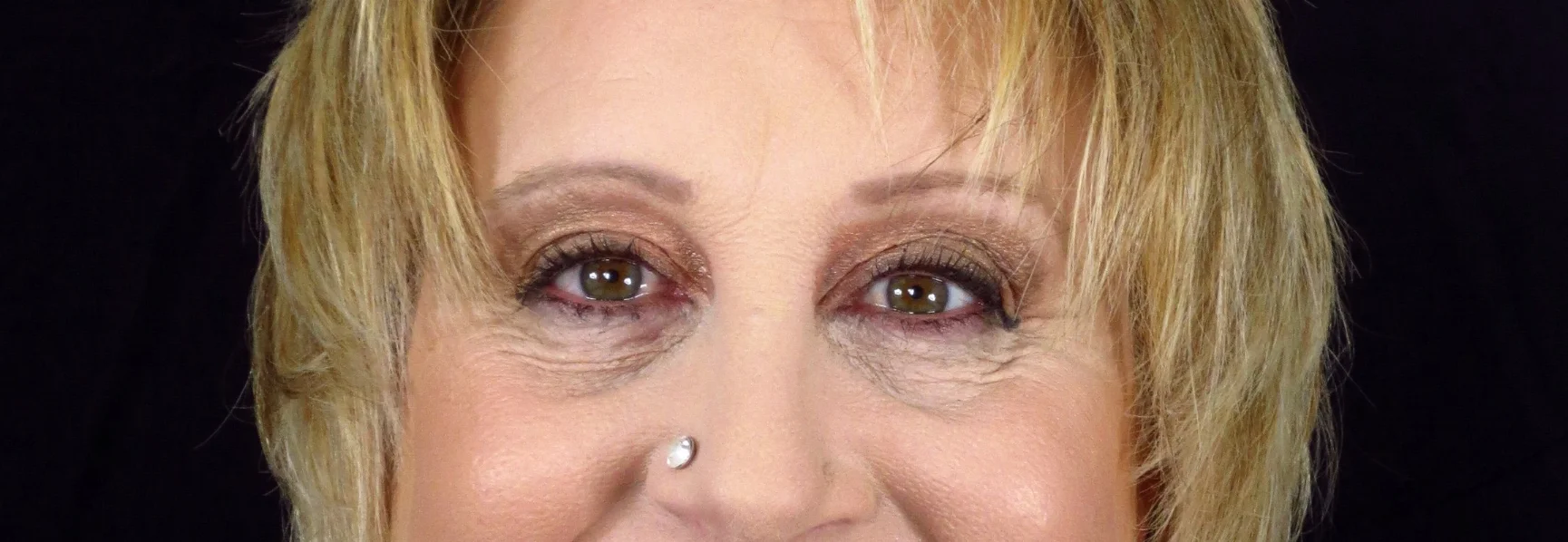 C.D- Erythema Coverage. This client had a Spider Naevi on her nose and some difficult damaged capillaries on her cheeks that she wanted to be able to cover. After a consultation we found a product and application method that she was happy with.