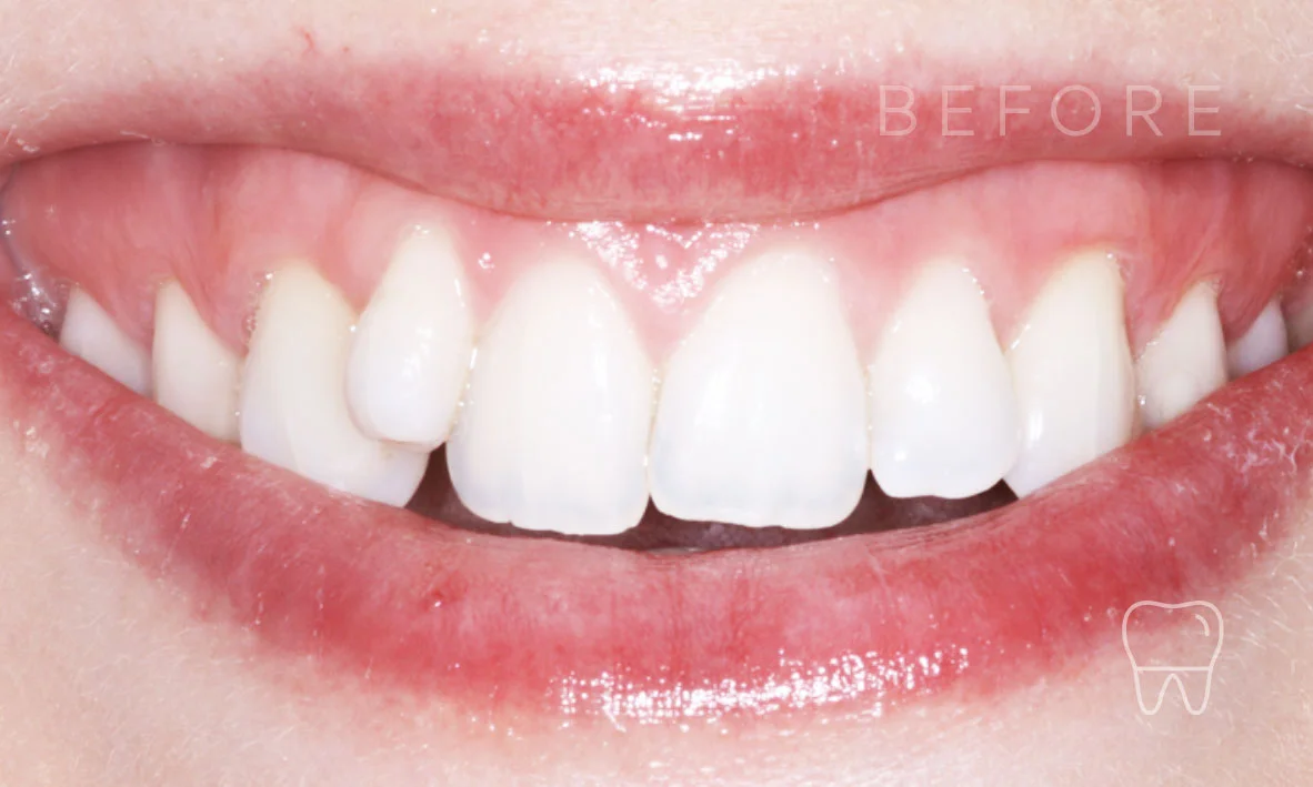 ©-Clear-Braces-Sydney-Patient-Alice-Before.jpg