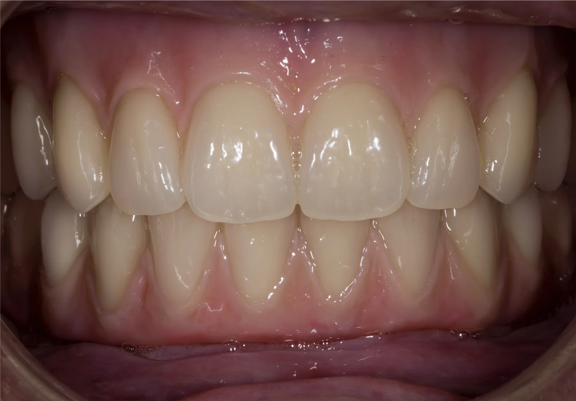 Day of insert -Full Upper and Ao4.jpg