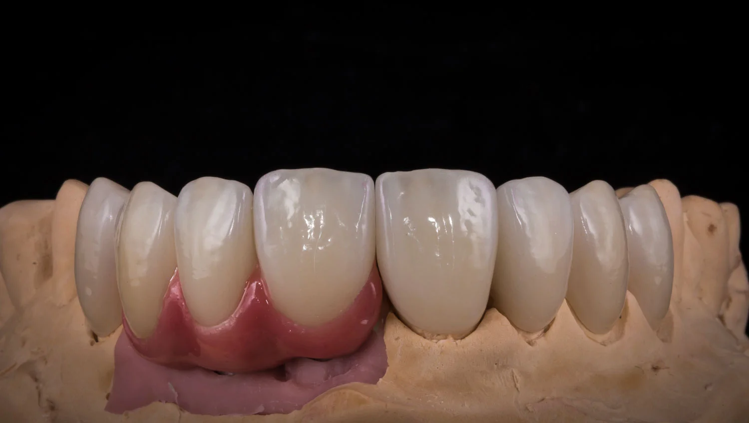 Implant Bridge & Veneers