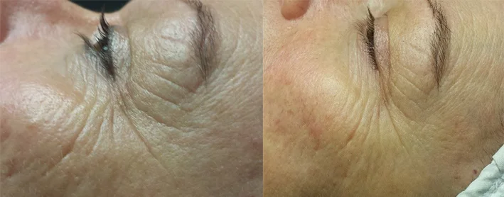 mesotherapie_esthetiquenathalieprimeau_avantapres_7.jpg