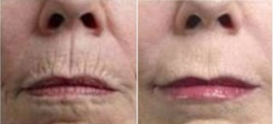 mesotherapie_esthetiquenathalieprimeau_avantapres_5.jpg