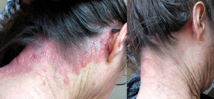 psoriasis.jpg