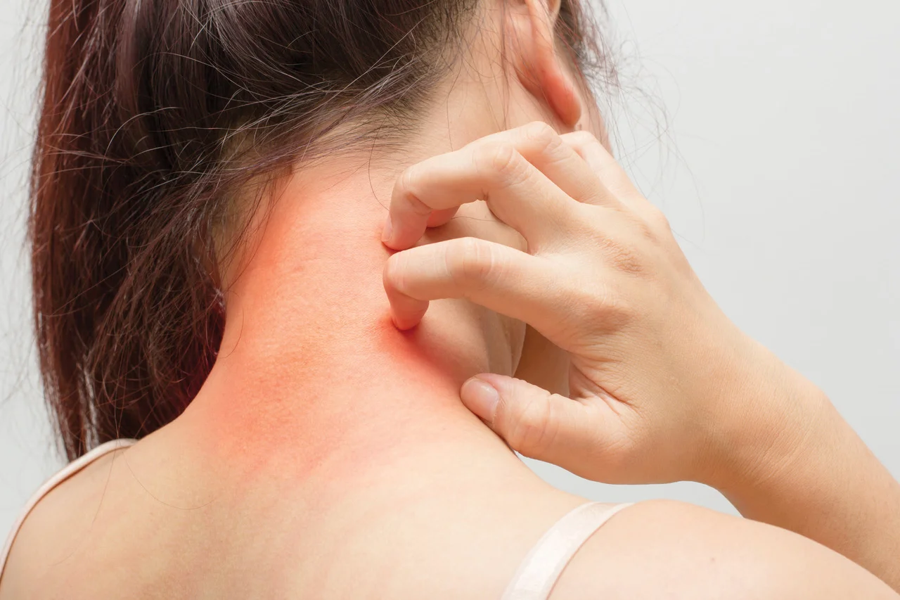 Treating Eczema with Chinese Medicine