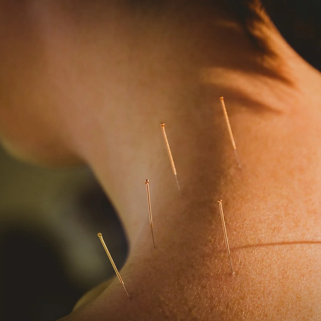 PASADENA OFFICE SPECIAL OFFER FOR ﻿WORLD ACUPUNCTURE DAY