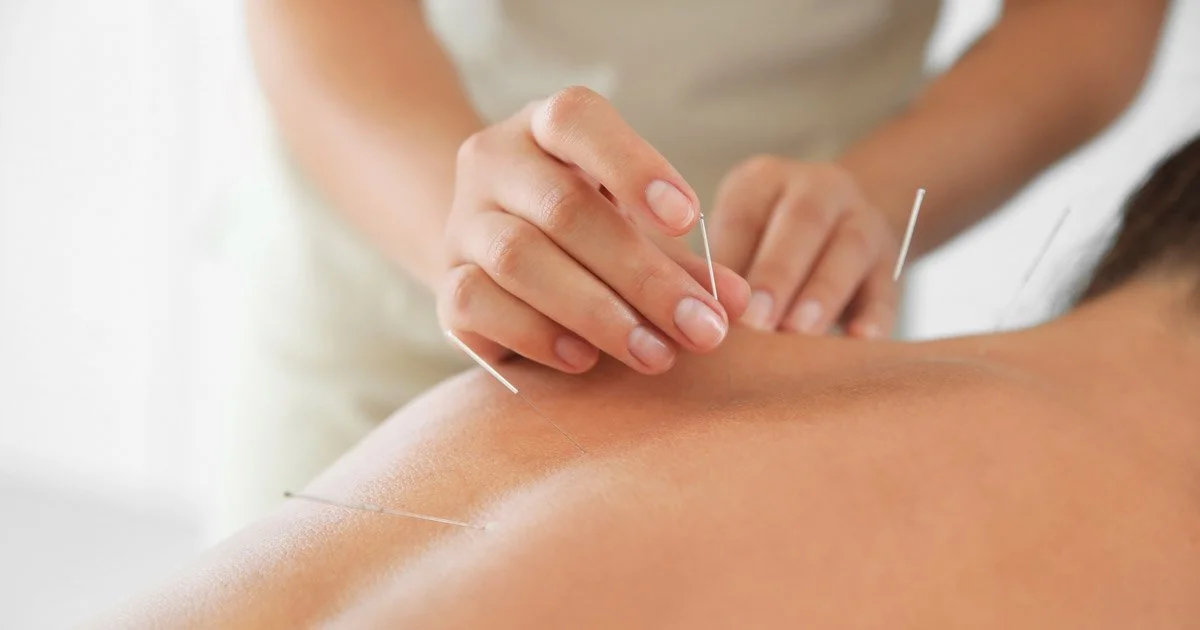 Why One Acupuncture Session Is Rarely Enough, and Why That’s Good News