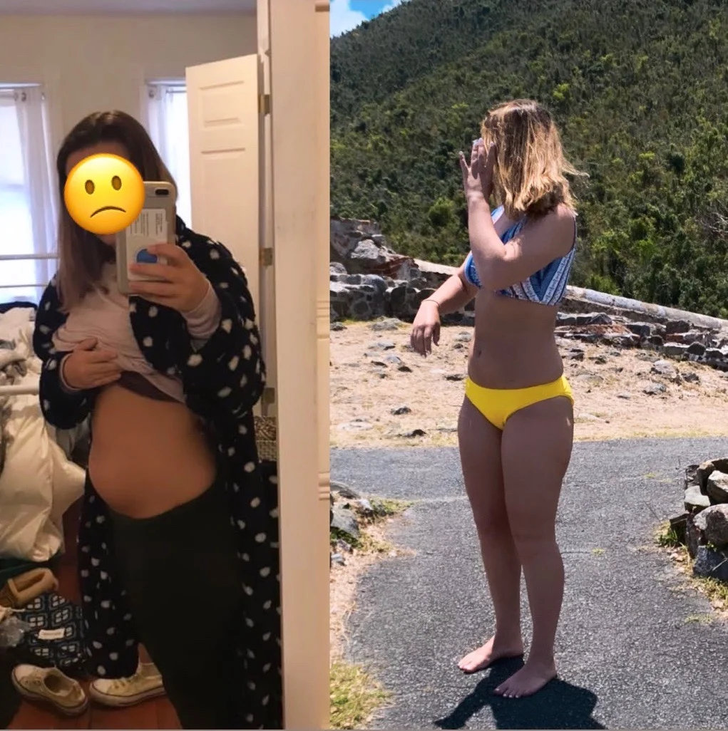 before and after surgery. 6 weeks later and my inflammation went down!