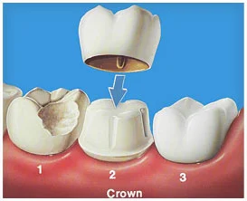 crowns_ClaudeSidiDentist.jpg