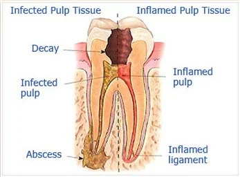 endodontic1.jpg