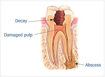 Step 1: Dr. Sidi examines and x-rays the tooth, then administers local anesthetics. After the tooth is numb Dr. Sidi places a small protective sheet called a "dental dam" over the area to isolate the tooth and keep it clean and free of saliva during the procedure.