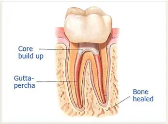 Step 4a: After the final visit with Dr. Sidi, you must return to have a crown or other restoration placed on the tooth to protect and restore it to full function.