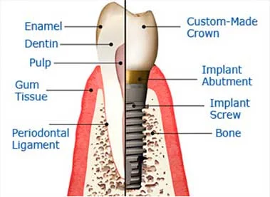 A dental implant is a titanium root form