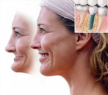 Diagnostic casts of your jaws are made and all of this information is presented to you along with treatment recommendations at a subsequent consultation appointment.