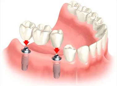 Implant-supported bridgeis supported by implants and not by natural teeth.