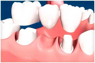 Dental bridges are highly durable and will last many years, however they may need replacement or need to be re-cemented due to normal wear.