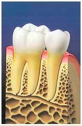 As the pockets deepen, it becomes impossible for you to clean the plaque out with brushing and flossing. Note here the buildup of plaque as it begins to damage the gum tissue.