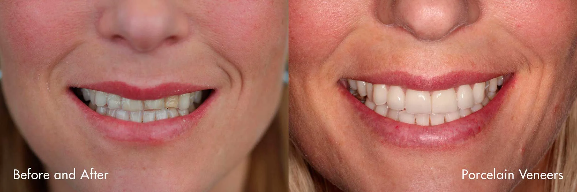 Veneers_0393Before+After.jpg
