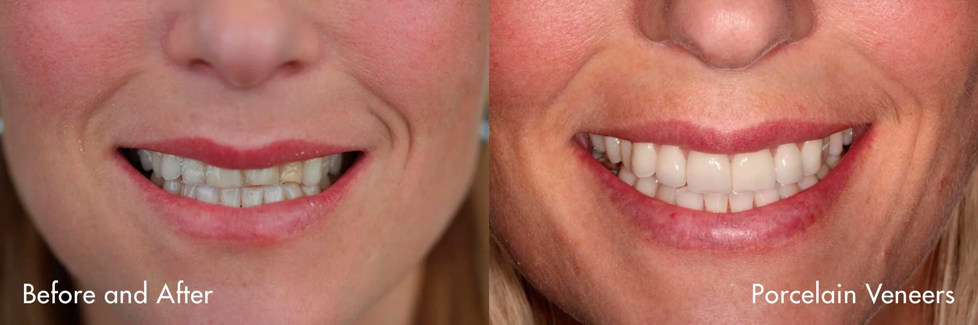 Veneers placed by Dr. Sidi in our office. Veneers can completely reshape your teeth and smile. They can often be alternatives to crowns and the ideal solution in treating many dental conditions.