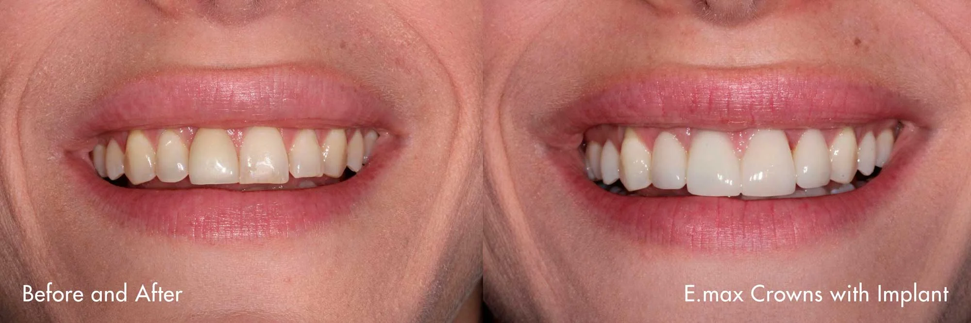 EmaxCrown_0417Before+After.jpg