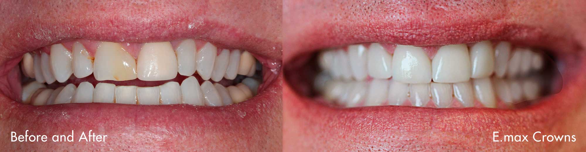 EmaxCrowns_NoImplant_Before+After.jpg