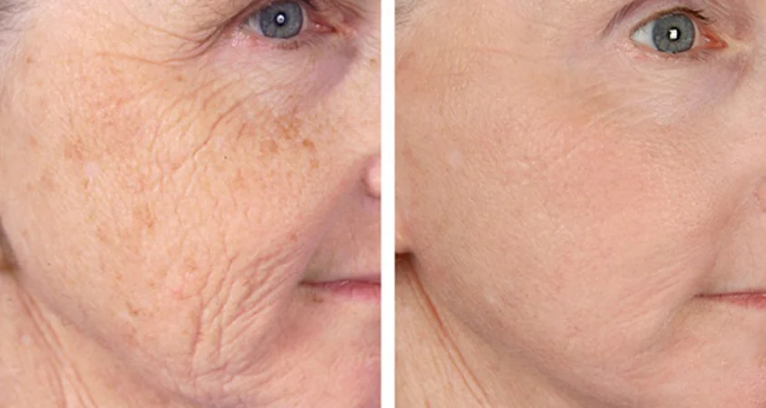 MICRO NEEDLING-1.jpg