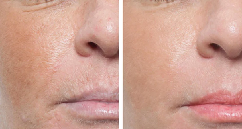 MICRO NEEDLING-3.jpg
