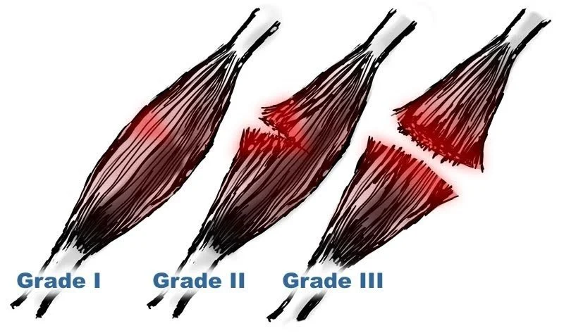 What is a muscle strain? 