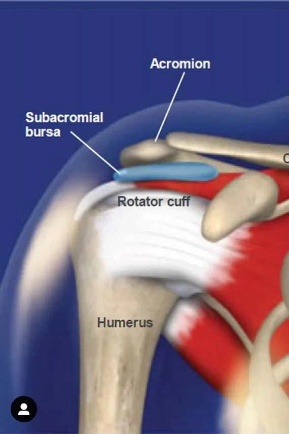 What is shoulder impingement?