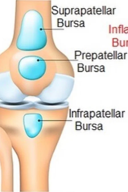 What is Bursitis?