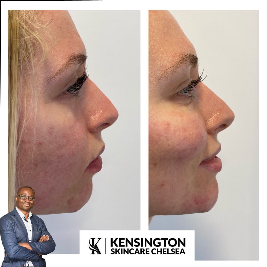 | Chin augmentation | 

The power of Chin Filler! 🤩

Another fantastic transformation by Dr Chike 🥼💉💧

This is a very popular treatment improve your natural harmonisation. 
It helps balance the side profile and reduce the jowly appearance. 

Visi