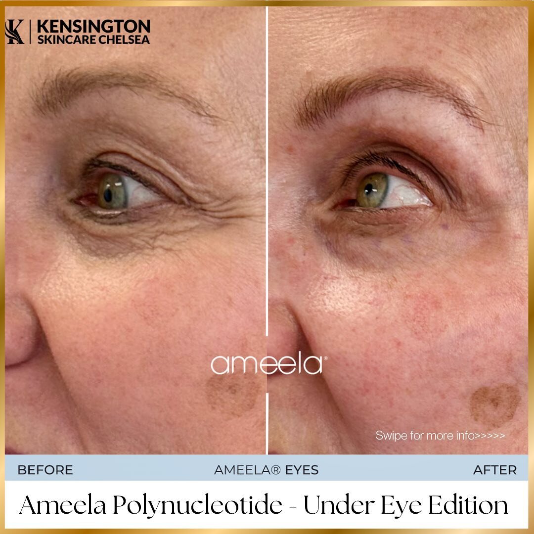💧💉👨🏾&zwj;⚕️Ameela Polynucleotide Treatment Benefits: 

🌟Skin Rejuvenation: Ameela Polynucleotide Treatment stimulates collagen production, renewing your skin from within. Say goodbye to dullness and hello to a revitalized complexion.

🌟Hydratio