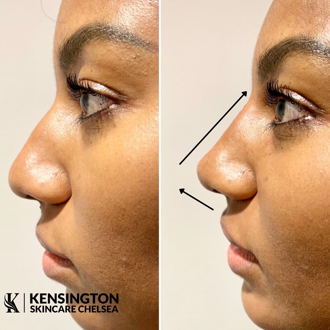 | 🌟NON SURGICAL RHINOPLASTY 🌟|

Did you know, It&rsquo;s possible for the nose to be straightened, to lift the tip and raise the bridge with this treatment to help create an overall more balanced and contoured appearance. 

Get in touch to arrange 