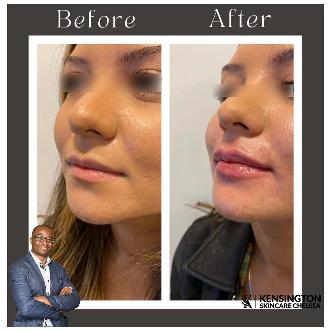 | LIP ENHANCEMENT |

Do you want a plumper pout but still want Natural Looking Lips? 

Lip filler injections provide very natural looking results due to their subtlety. There is no need for drastic changes; instead, this type of treatment gives you m