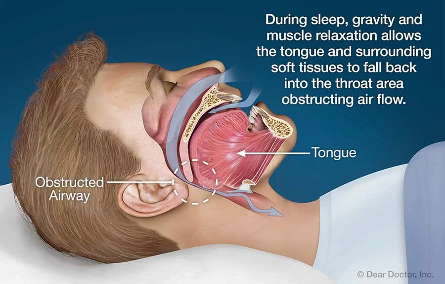 How an obstructed airway is formed, blocking the vital pathway for oxygen while we sleep.