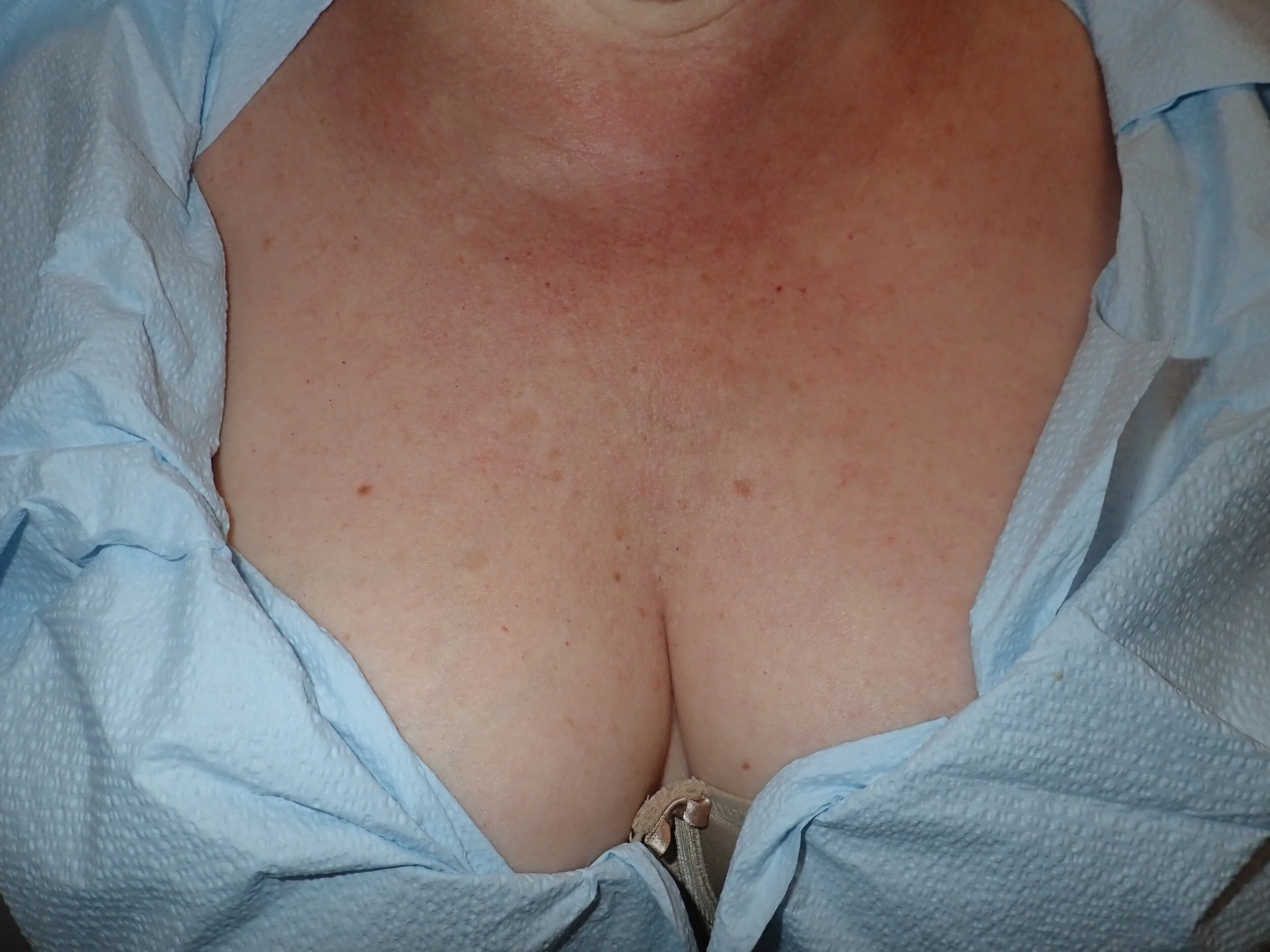 SS POst Sculptra and REsurFX.jpeg