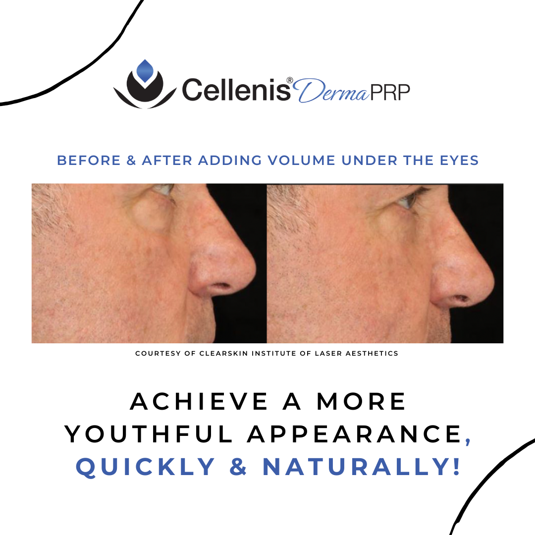 Cellenis PRP Derma Filler — HELIOS LASER CENTER